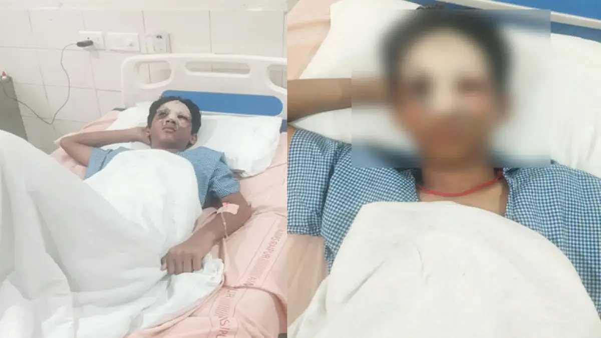 घरवालों की डांट से बचने बच्चे ने गढ़ी एसिड अटैक की झूठी कहानी